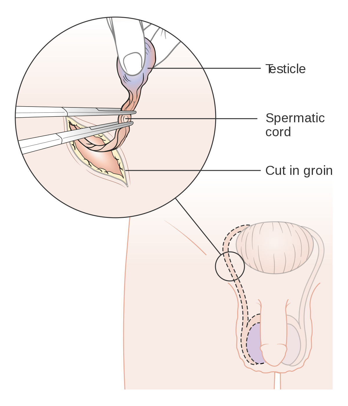 Diagram_showing_how_the_testicle_is_removed_(orchidectomy)_CRUK_141.svg